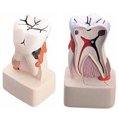 Dental Pathology Model